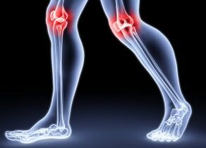 Razones para desarrollar la artrosis de la rodilla