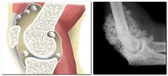 Condromatosis con dolor en la articulación de la cadera.