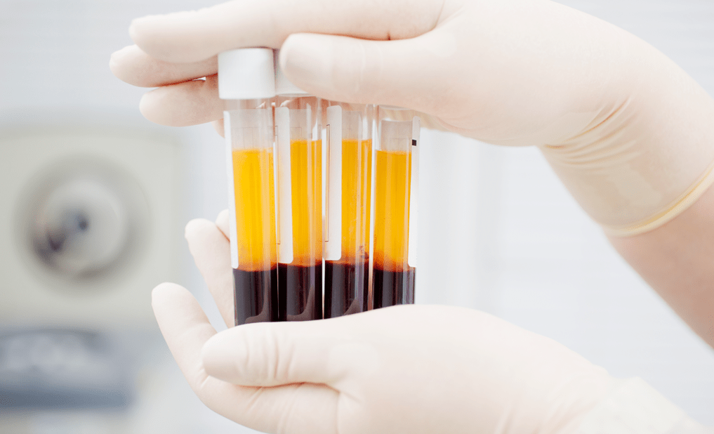 Plasma rico en plaquetas para el tratamiento con PRP de la artrosis